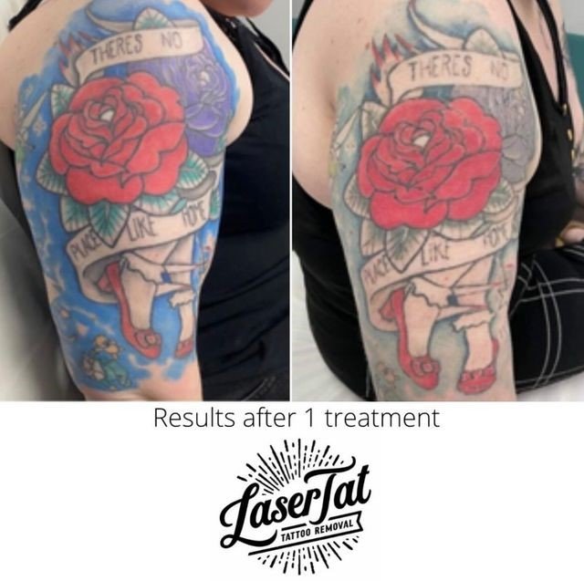 Alyssa Zebraskys Face Tattoo Removal Journey  Removery