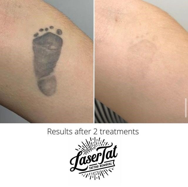 Can Laser Tattoo Removal Cause Blistering? | MEDermis Laser Clinic
