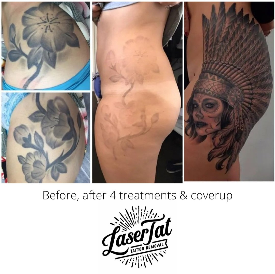 PFD patch and tattoo removal, the dawn of a new day - Black Sage Tattoo  Removal