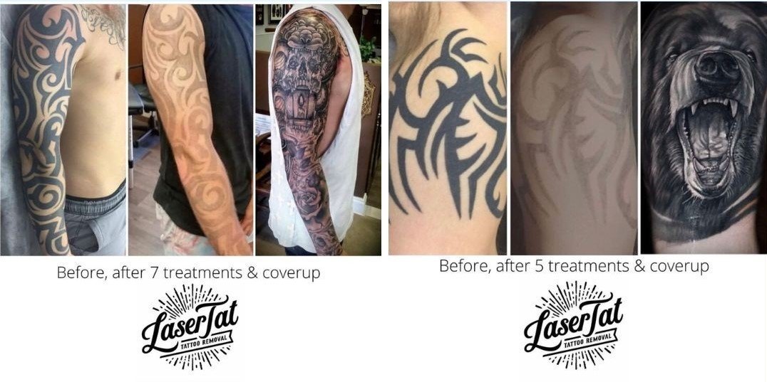 Borderline Tattoo Collective  Laser Tattoo Removal