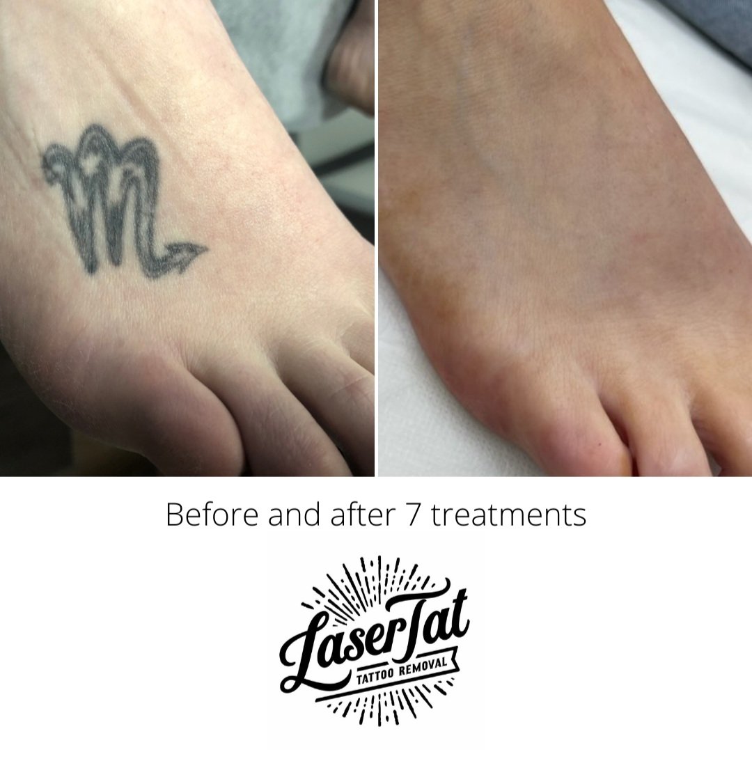 Laser Tattoo Removal - Lutronic United States