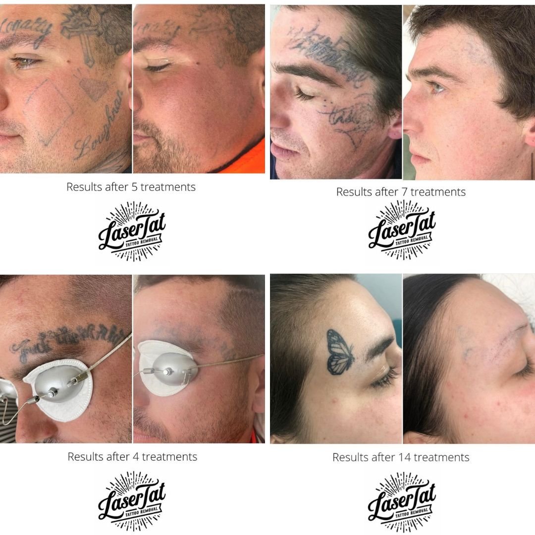 How Many Laser Tattoo Removal Treatments will I Need 