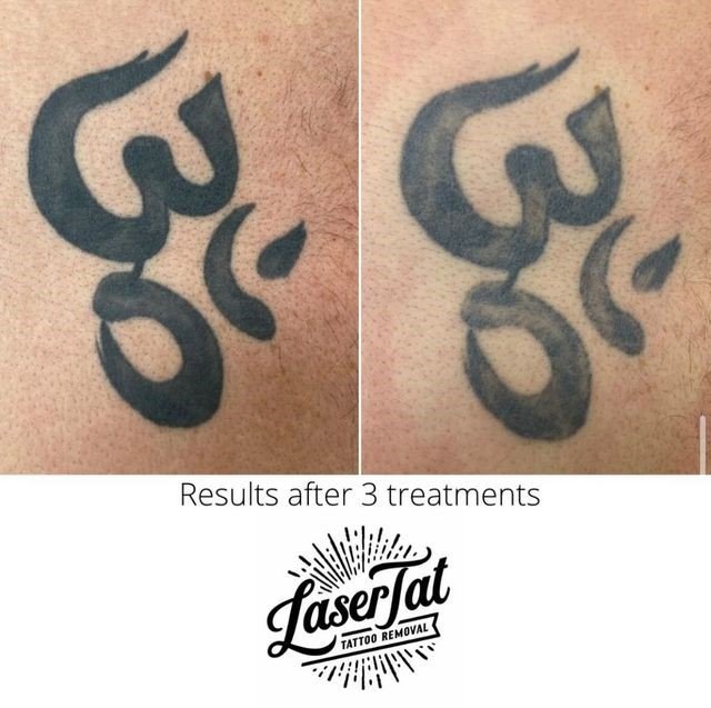Laser Tattoo Removal How long until you can see results? — LaserTat