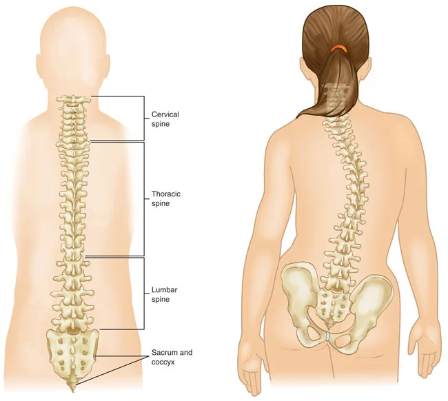 scoliosis spine.jpg