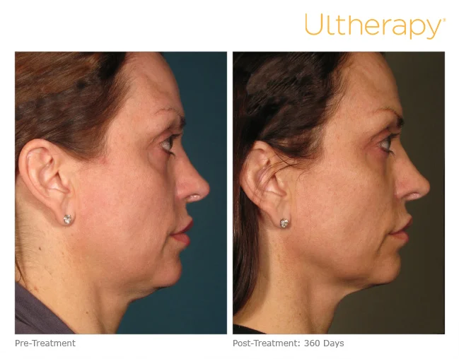 ultherapy-000p-015y_before-360daysafter_full.jpg