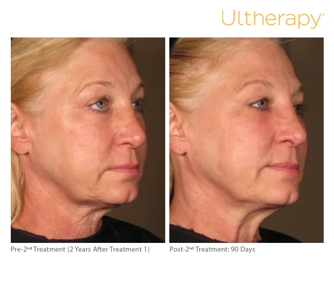 ultherapy-0108c-d_2yrposttx1before-90daysaftertx2_full.jpg