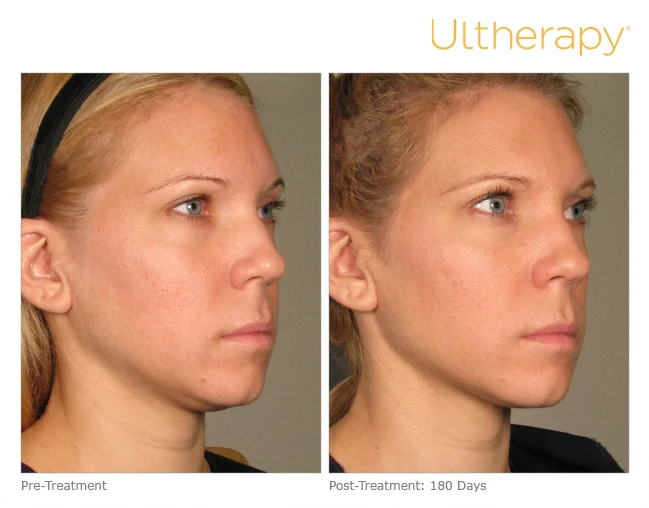 ultherapy-p011_before-180days_full.jpg