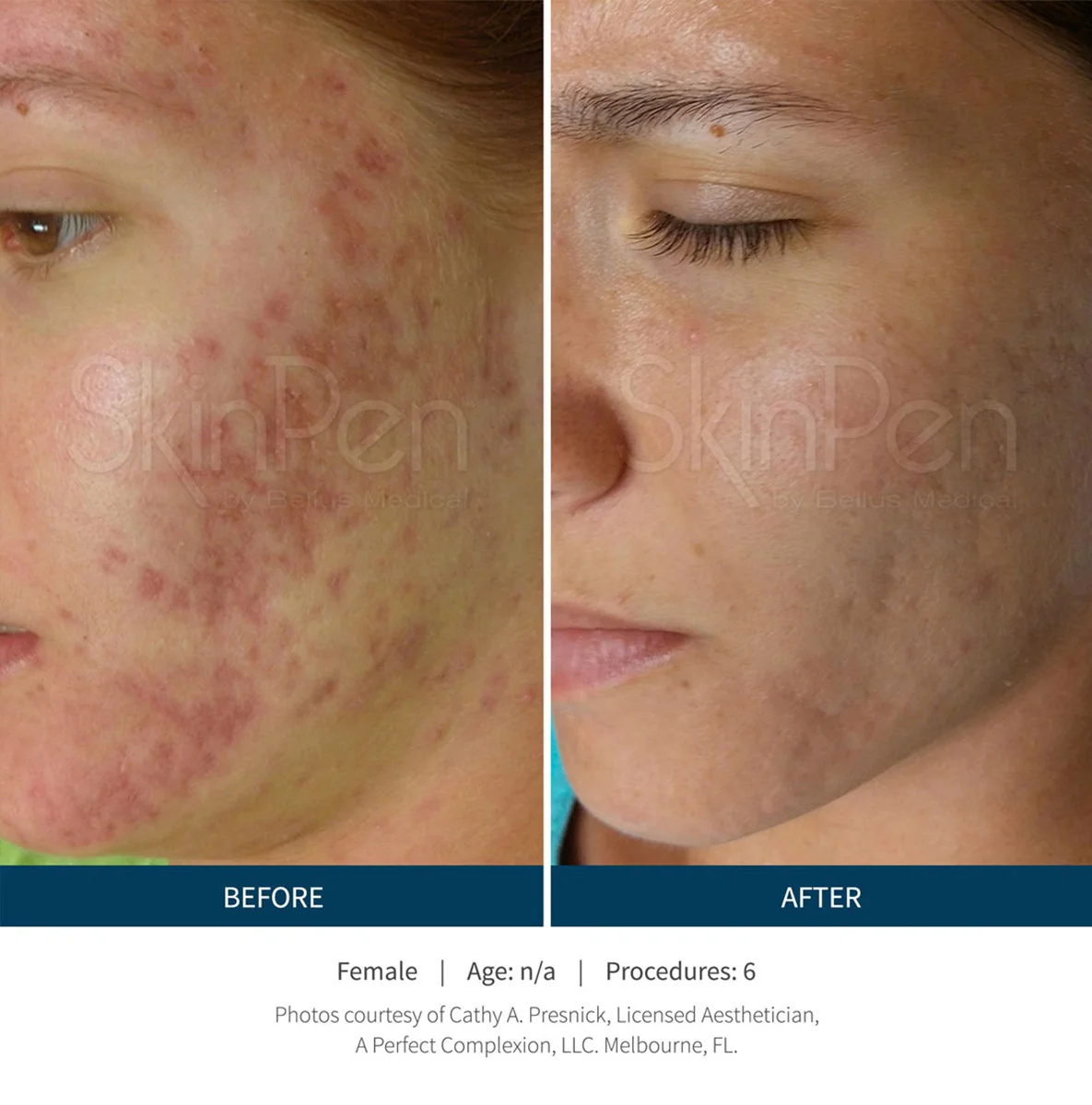 skinpen-acnescars-microneedling-v2-1-1.jpg