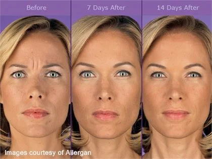 76a32511b8184704b43f362d8dd39ad5--botox-fillers-botox-injections.jpg