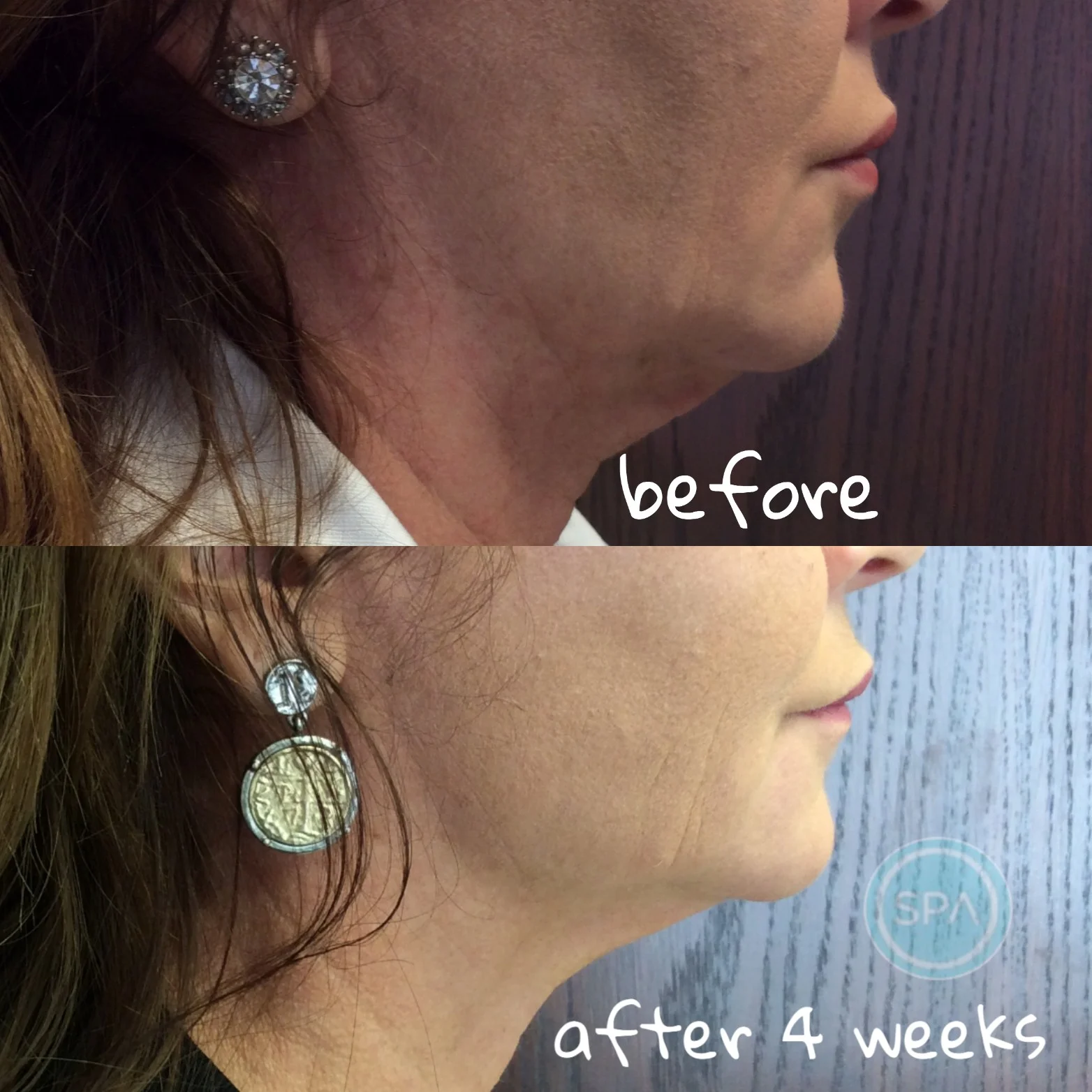 Morpheus8 Face Sculpting & Remodeling — Skin Care Services — Skin