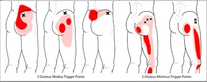 The figure above shows three different trigger points in the muscle and the pain referral pattern for each. All three of these referral patterns present on a regular basis. Patients come in with low back pain and are surprised to learn it’s not their low back at all, but their glutes. The glute med is constantly firing when we are upright so it makes sense that the muscle is overworked.