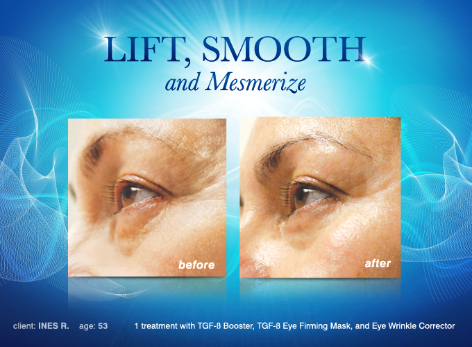 eye wrinkle corrector