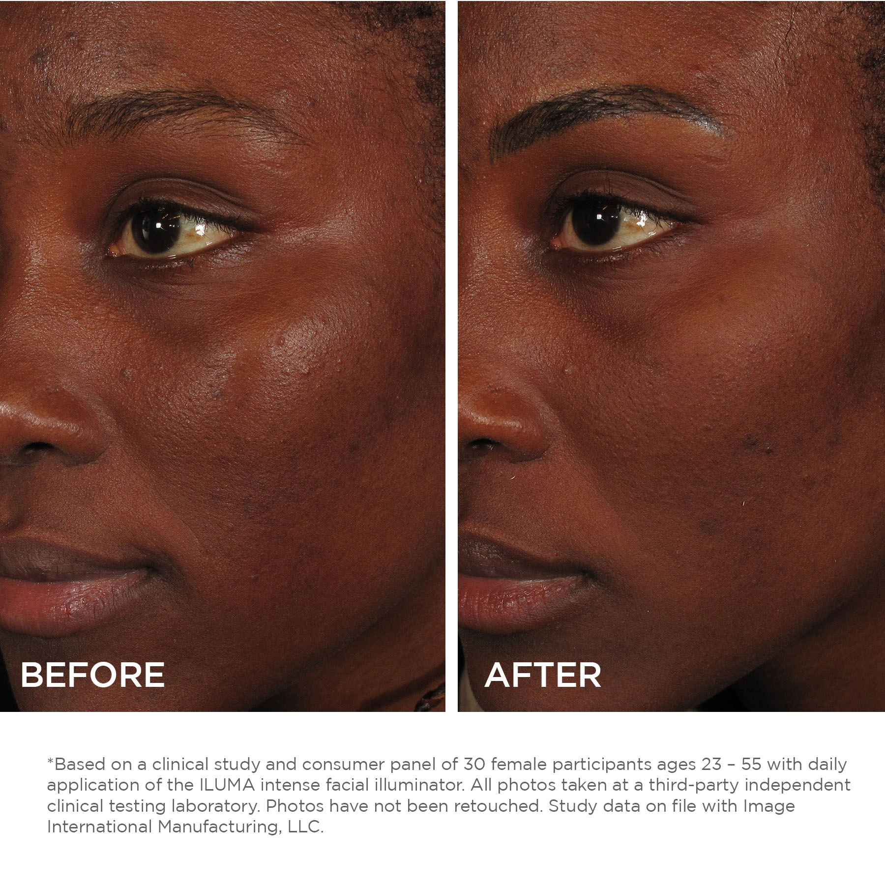 Before and After - ILUMA Intense Facial Illuminator