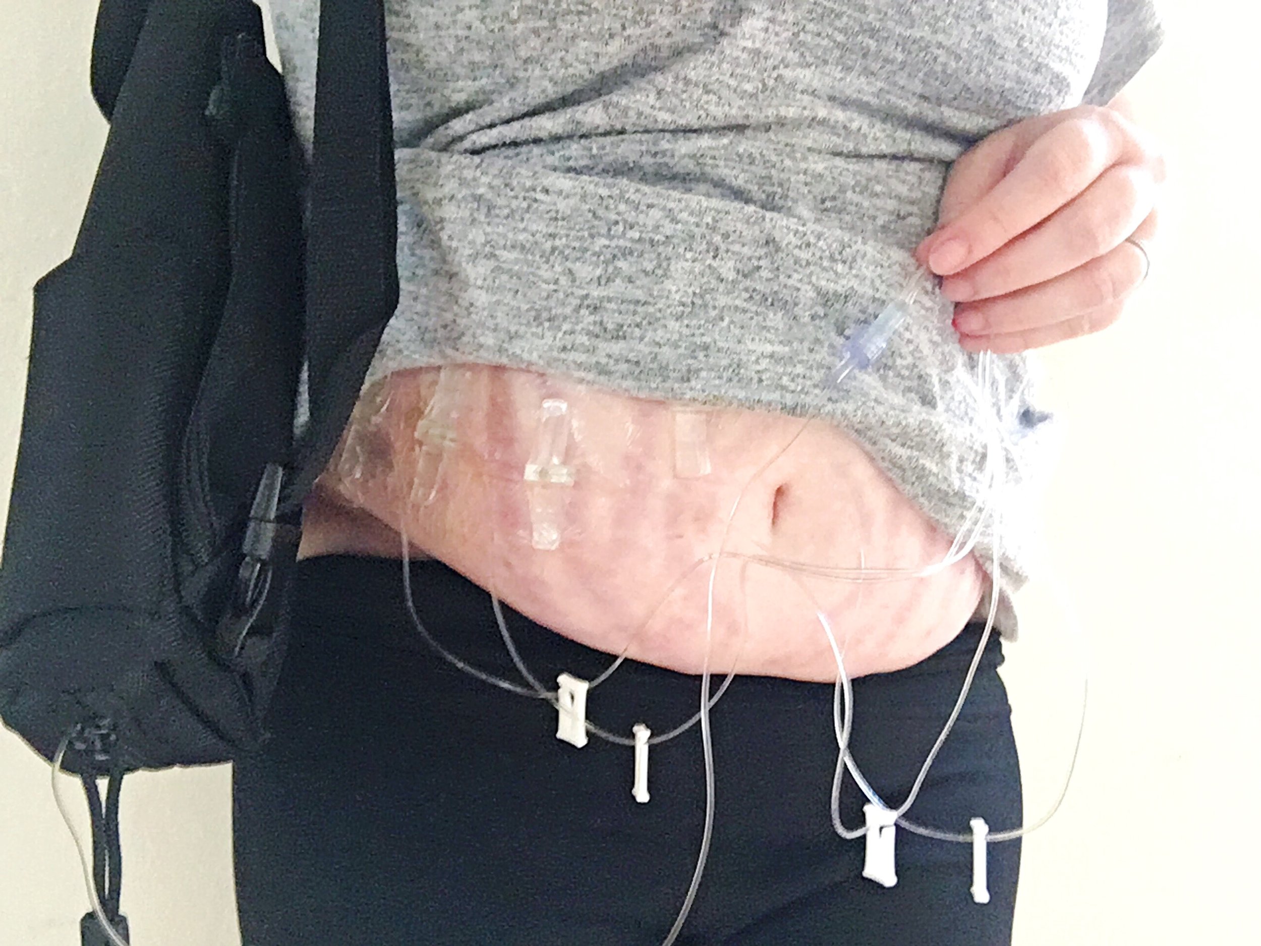 Giving my weekly SCIG infusion at home.