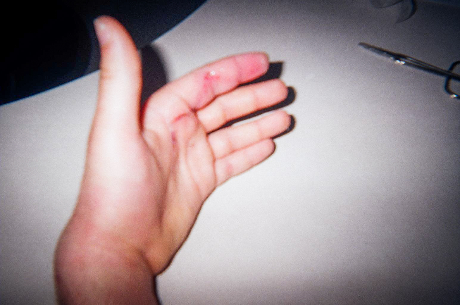 Splints-11.jpg