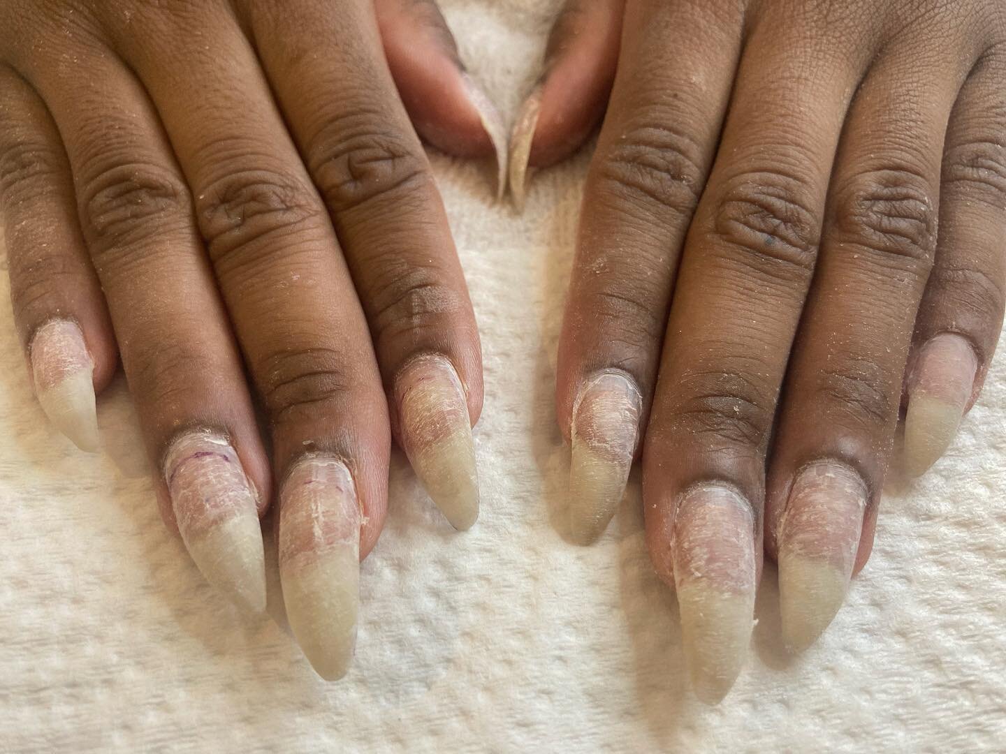 Polygel removal and new overlay application.

No matter the service maintaining the integrity of the natural nail is always my goal. 

This client started off with nails half the length of 1st photo. 
I recommend anywhere between 3-5 fills before sta