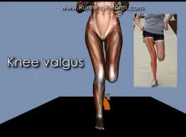 valgus-knee .jpg