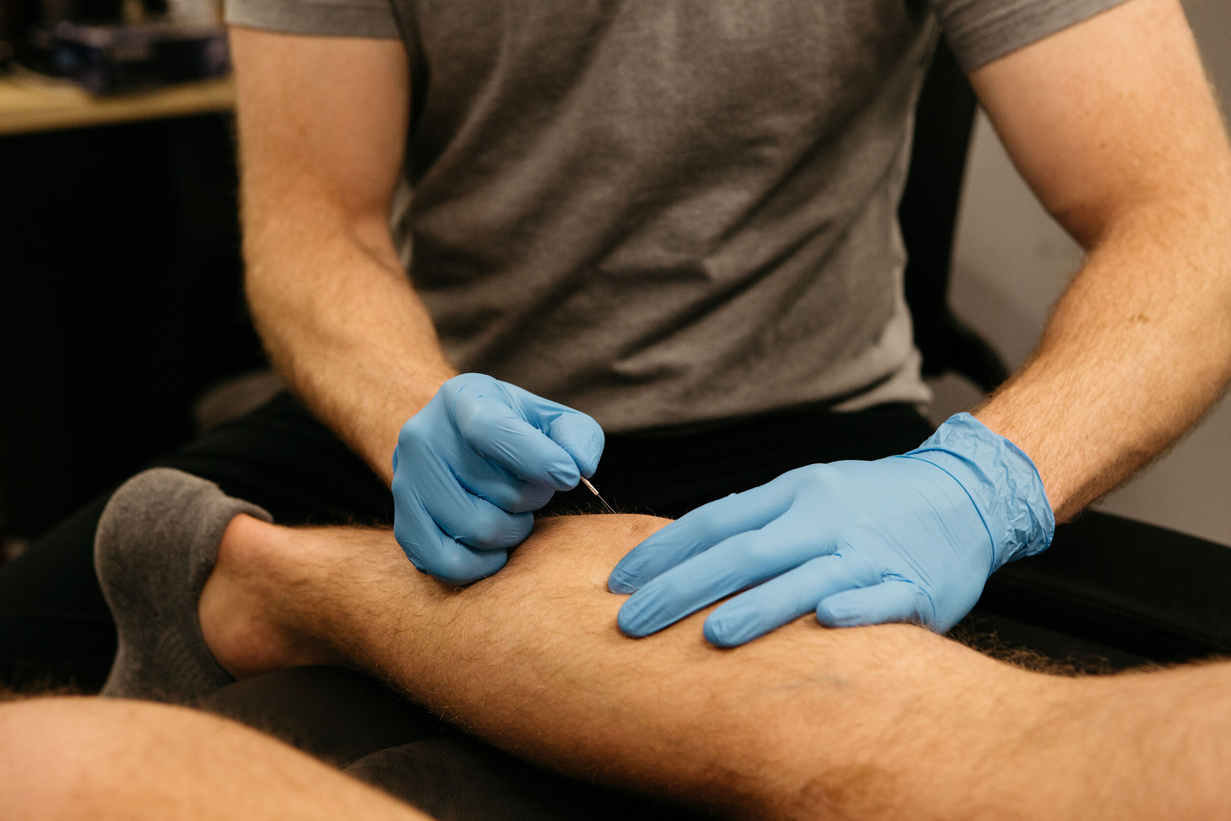 Dry Needling In Rochester Hills Michigan Limitless Physical Therapy And Performance