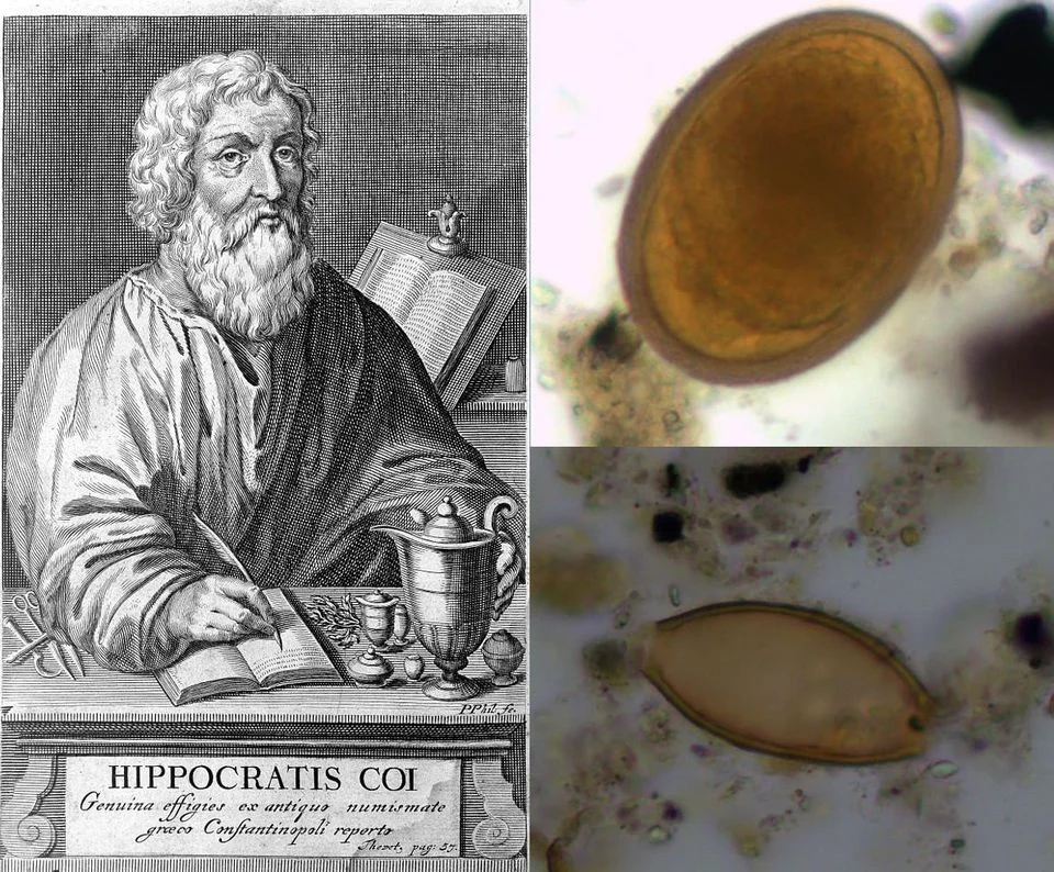 Portrait of Hippocrates of Kos, along with archaeological evidence of roundworm (top right) and whipworm (bottom right) found in burials on the nearby island of Kea.
