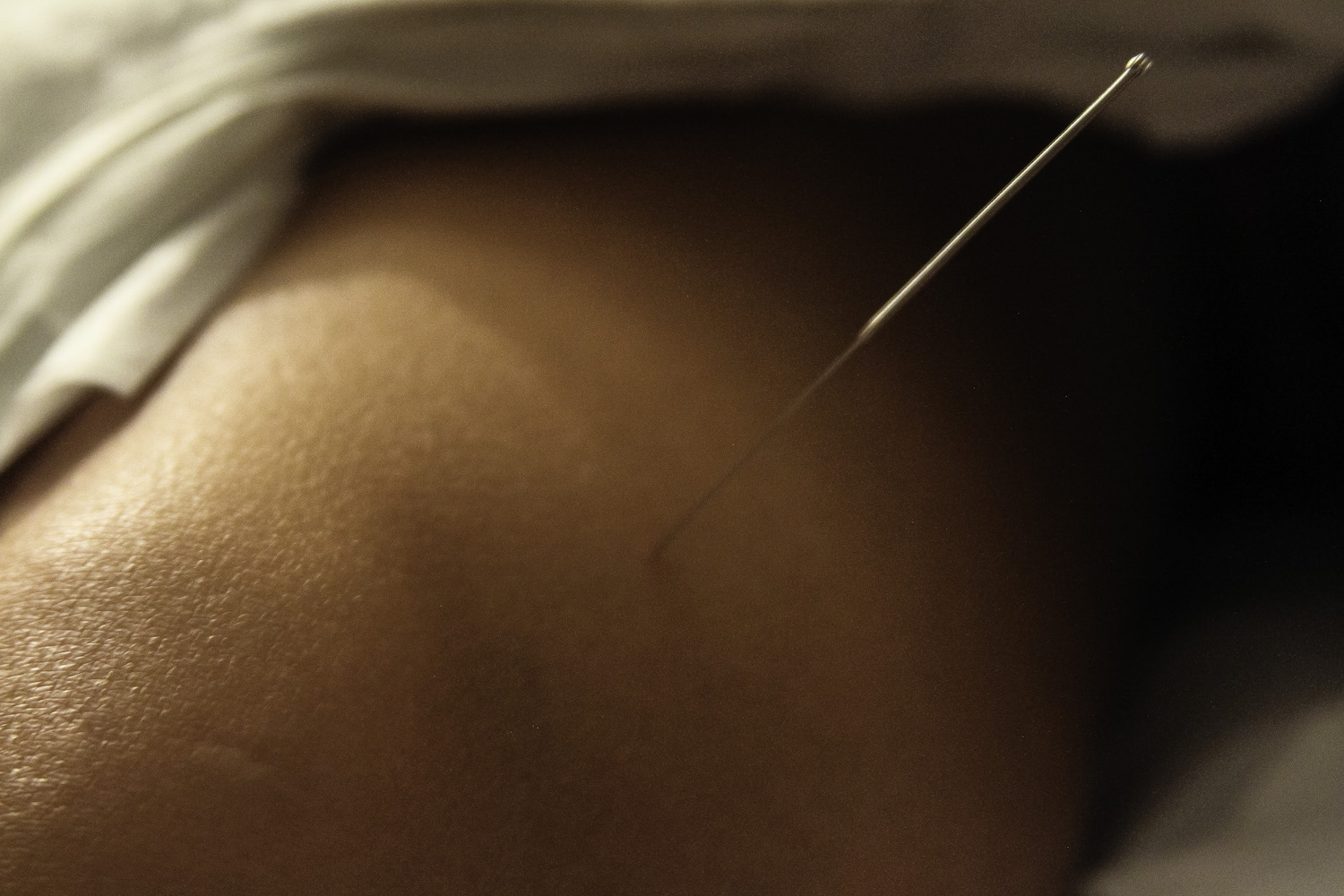 Acupuncture needle. © H. Lan Thao Lam, 2017.