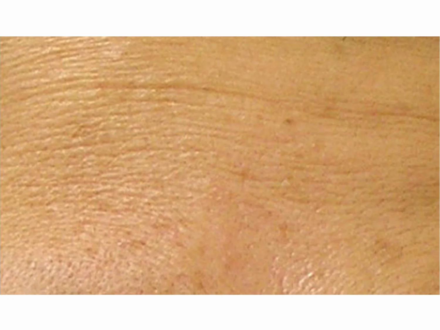 Fine Lines and Wrinkles