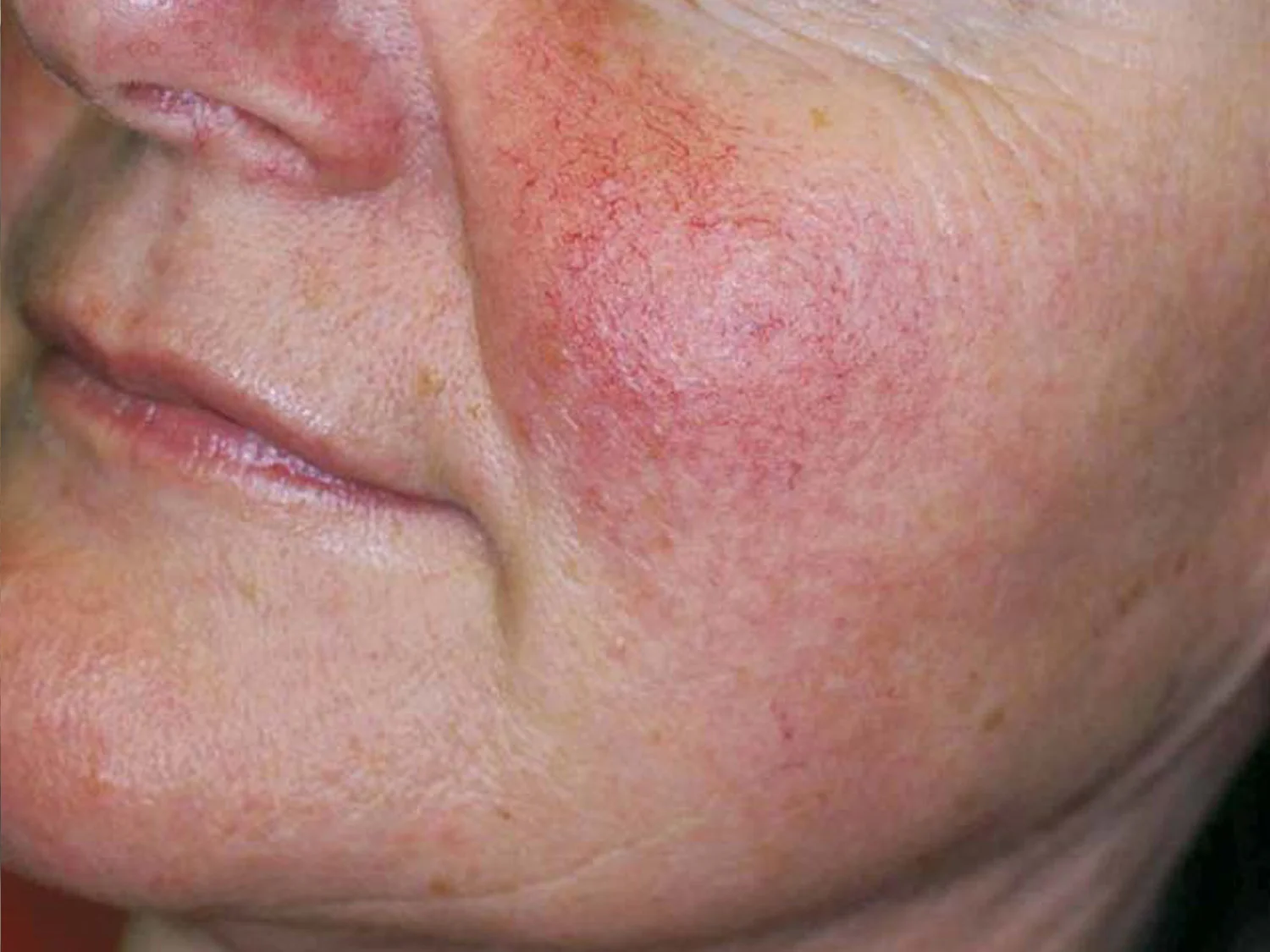 Rosacea & Spider Veins