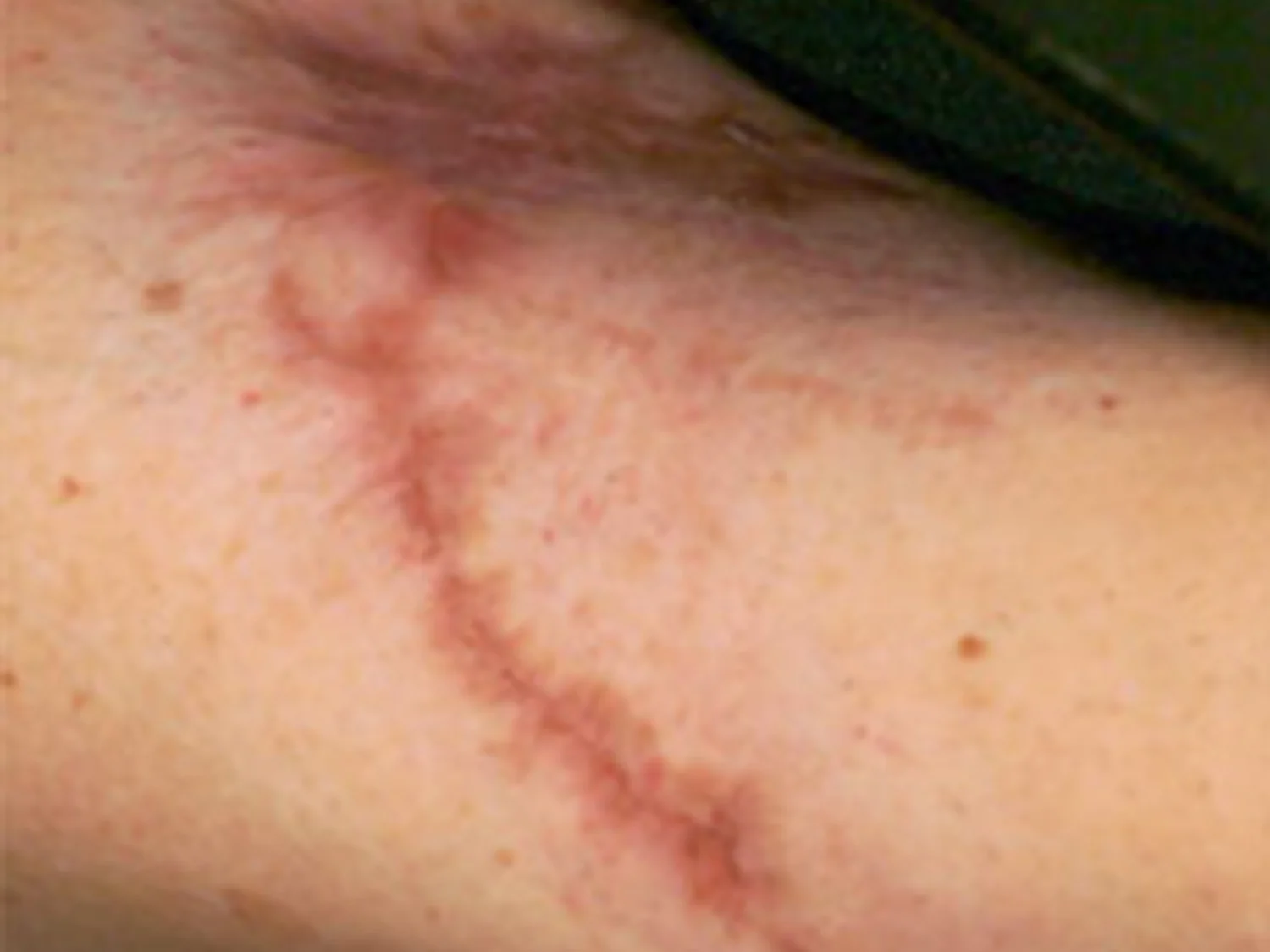 Scar