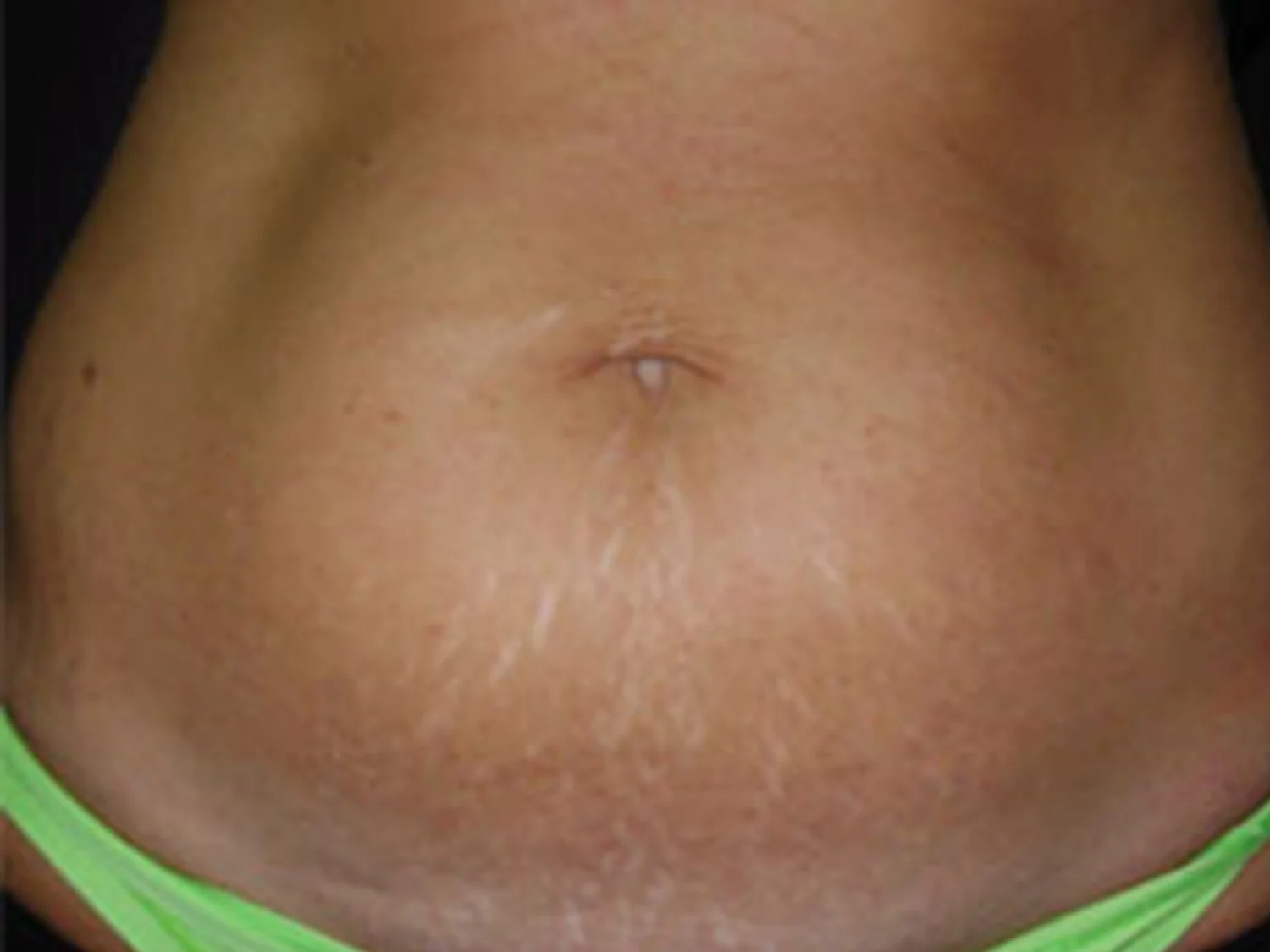 Stretch Marks