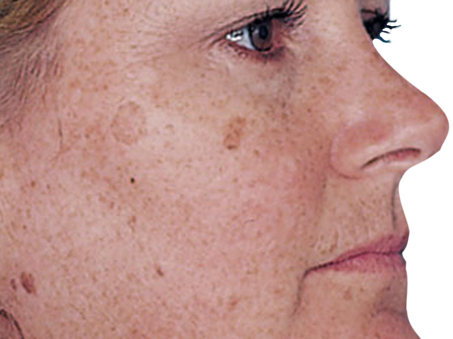 Treat Hyperpigmentation, Brown Spots, Sun Damage