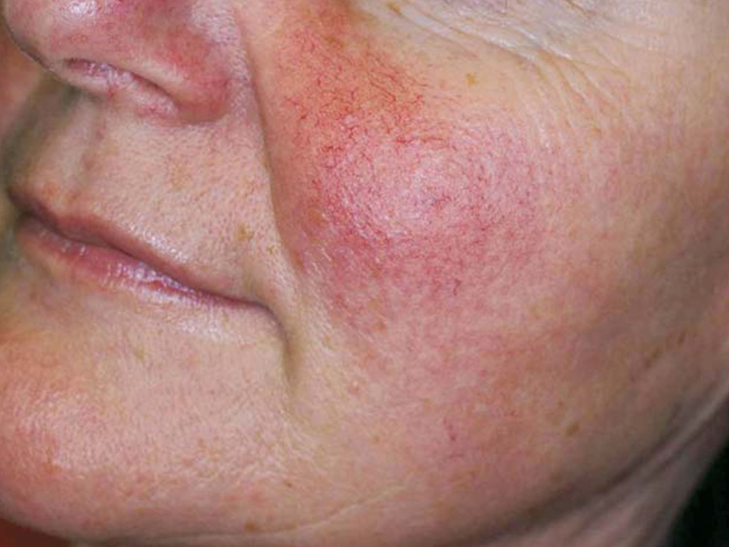 Treat rosacea, redness, spider veins