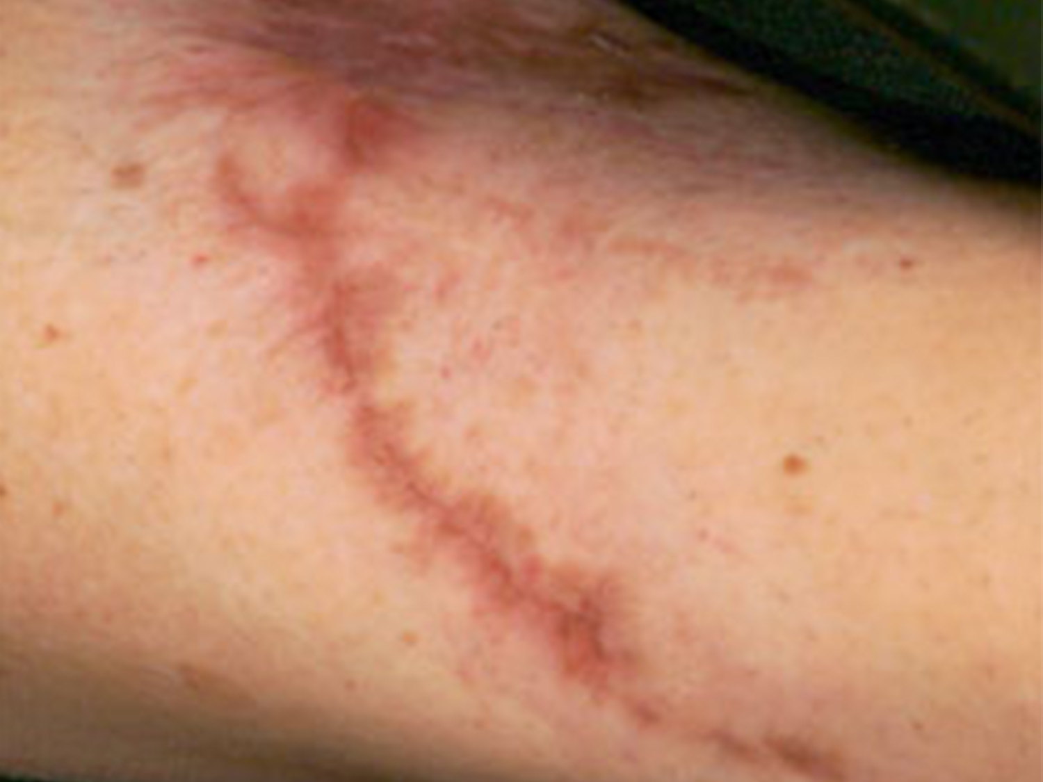 Treat surgical scars and other scars