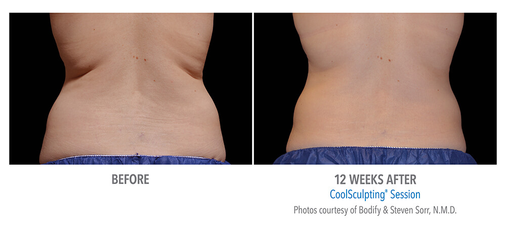 CoolSculpting® Ottawa - Non-Invasive Fat Reduction - Concept Medical