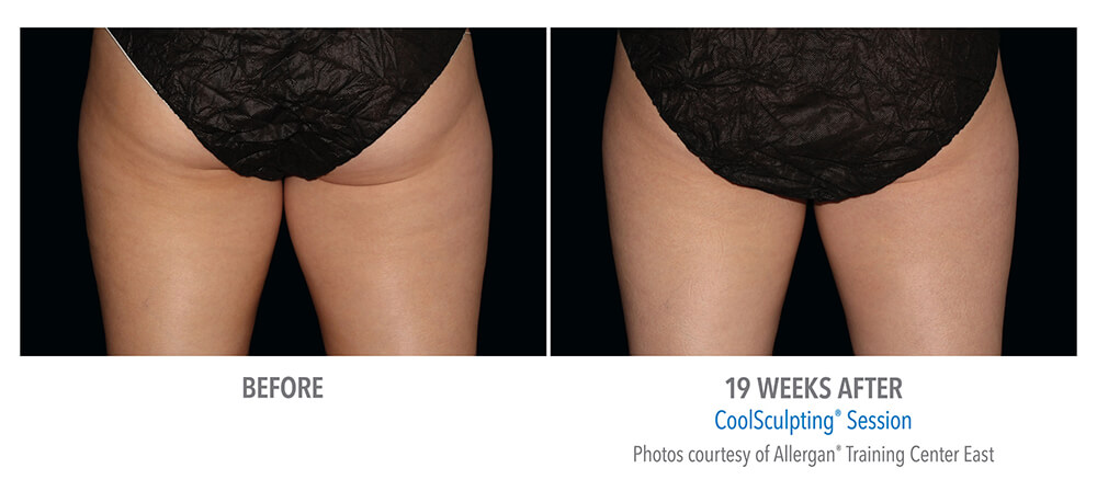 CoolSculpting® Ottawa  Body Contouring at Kanata Skin Clinic