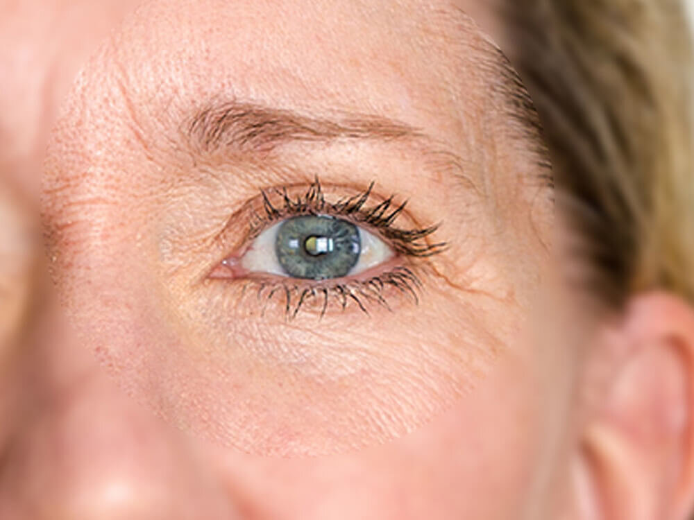Treat wrinkles around the eyes and forehead