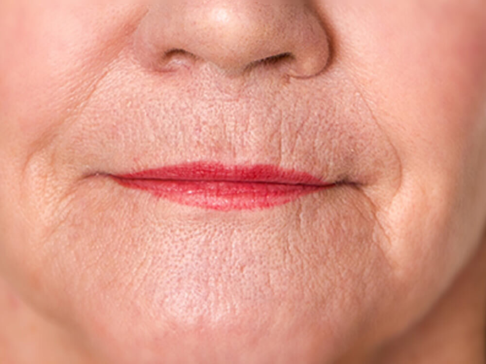 Treat wrinkles around the mouth