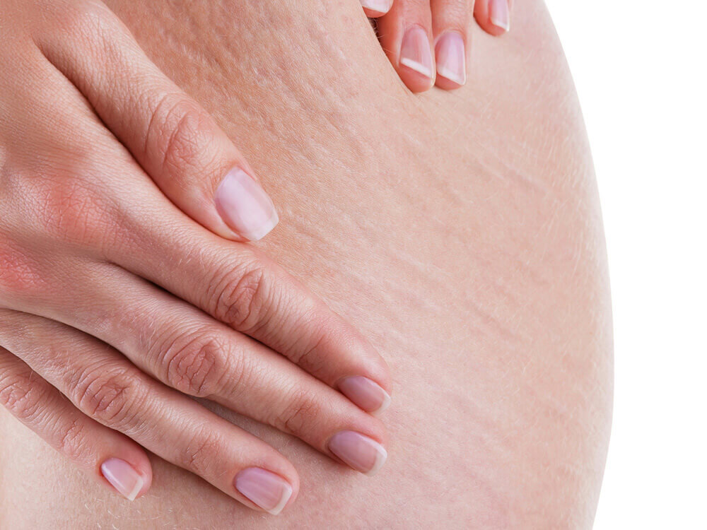 Treat stretch marks