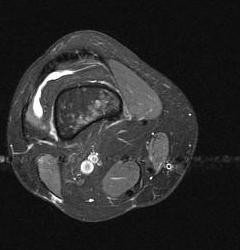 MRI after tearing up my knee.