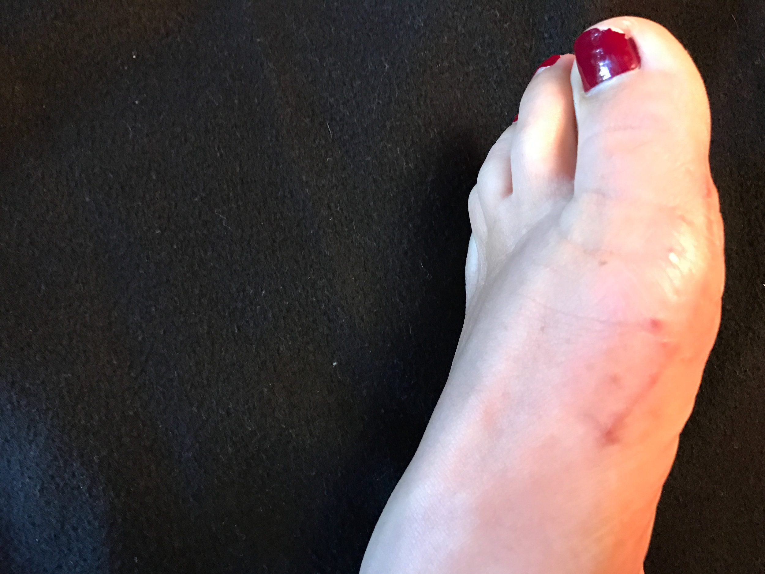 My scar is now nearly invisible. I'm so amazed and impressed with my surgeon. 