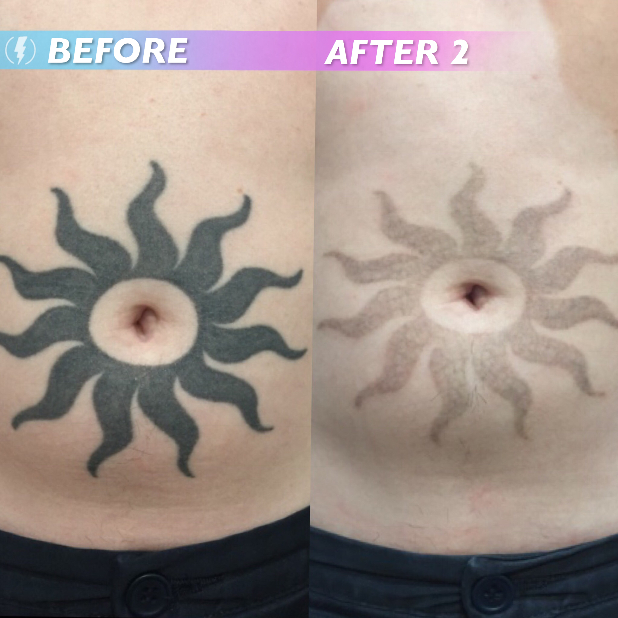 Adelaide's best laser tattoo removal and fading service with exceptional  results! — The Tattoo Removal  Tattoo Removal Adelaide