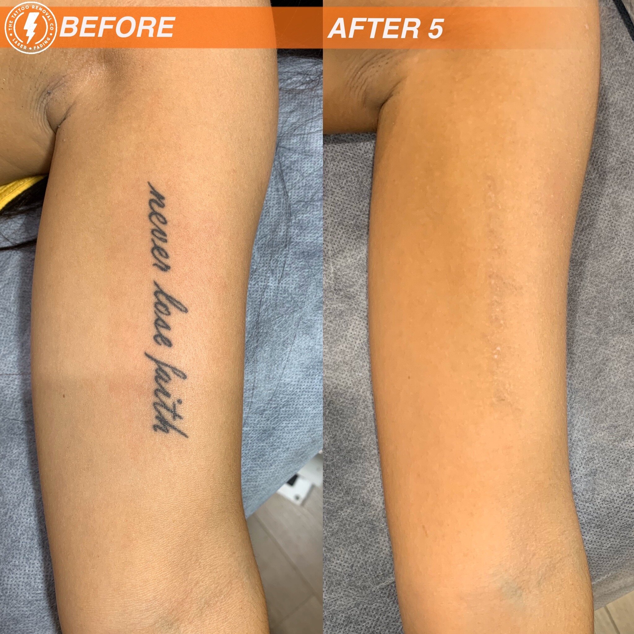 The Tattoo Removal Co.-Laser Tattoo Removal Adelaide