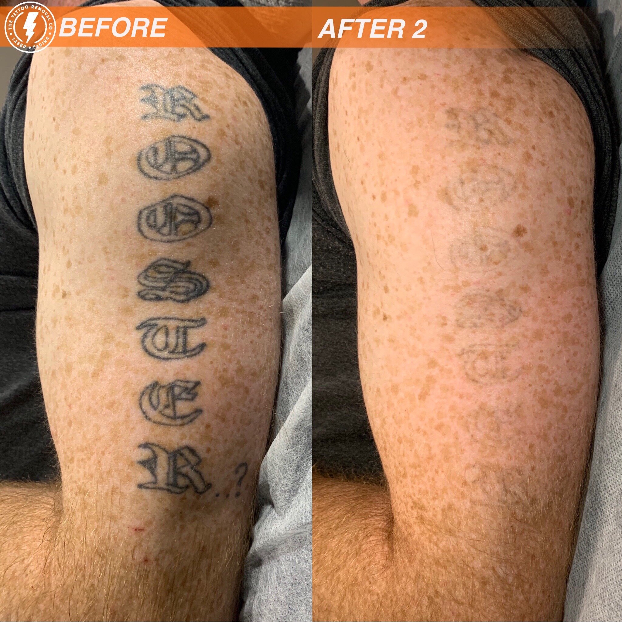 The Tattoo Removal  Tattoo Removal Adelaide