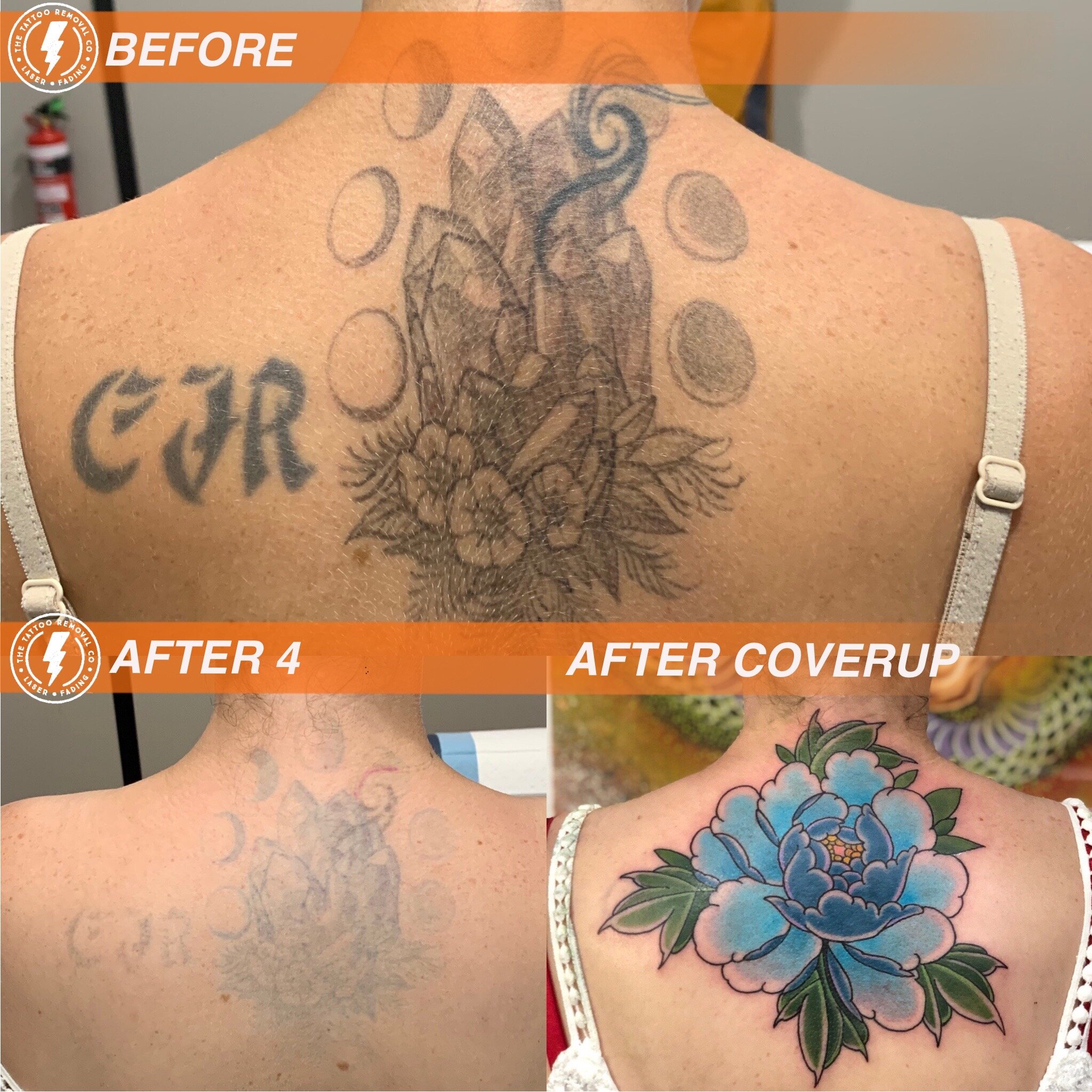 The Tattoo Removal  Tattoo Removal Adelaide