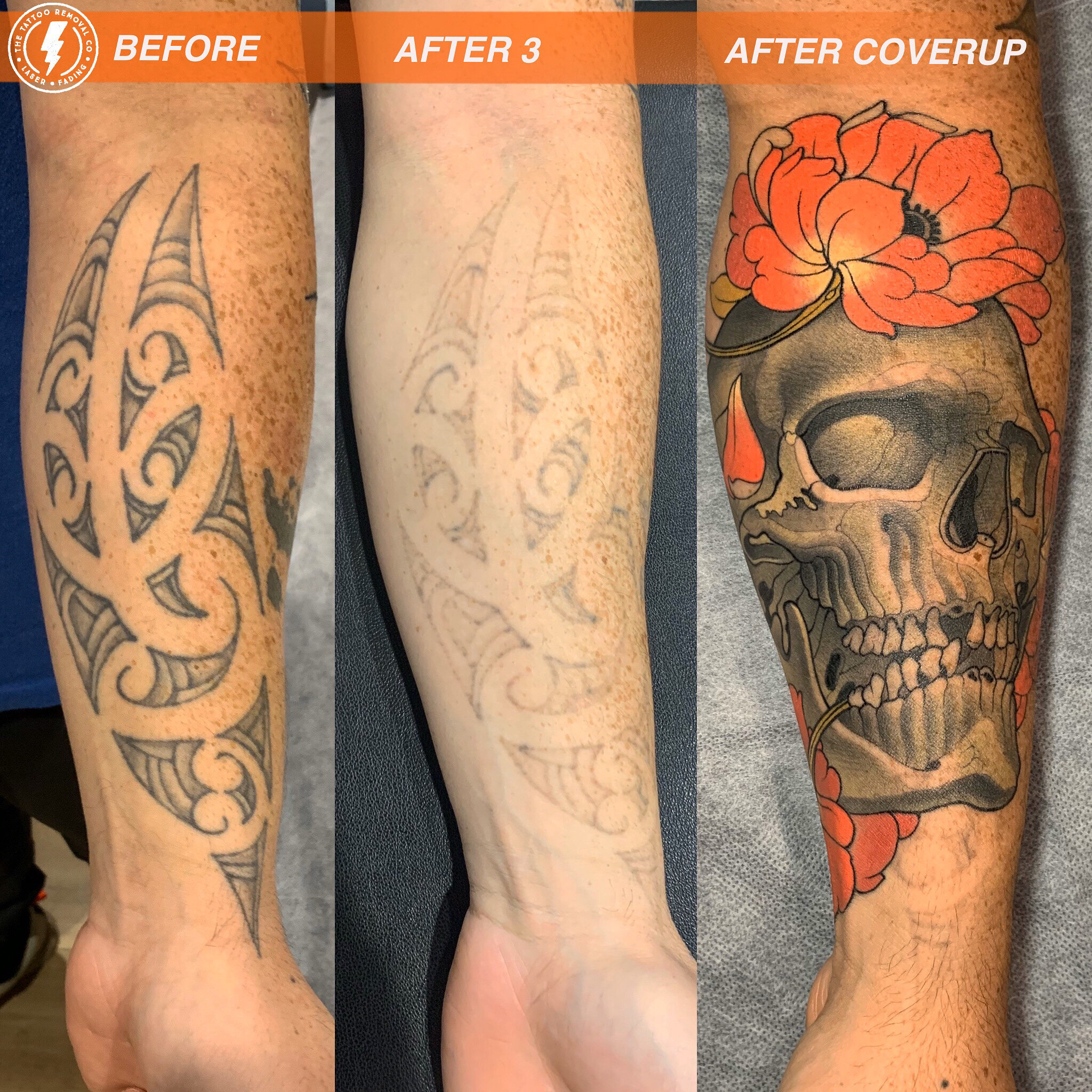 Adelaide's best laser tattoo removal and fading service with exceptional  results! — The Tattoo Removal  Tattoo Removal Adelaide