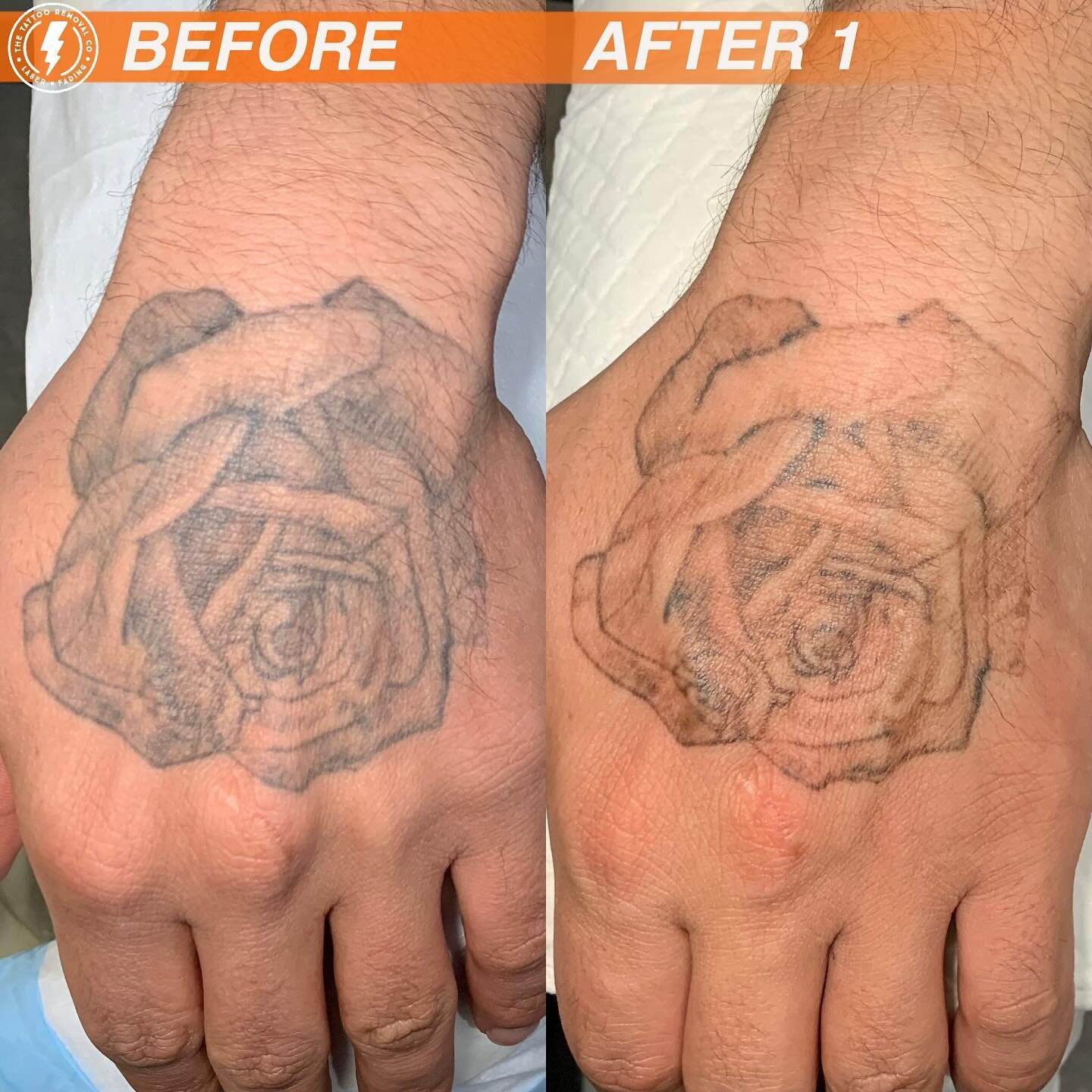 Aggregate more than 125 rose tattoo removal
