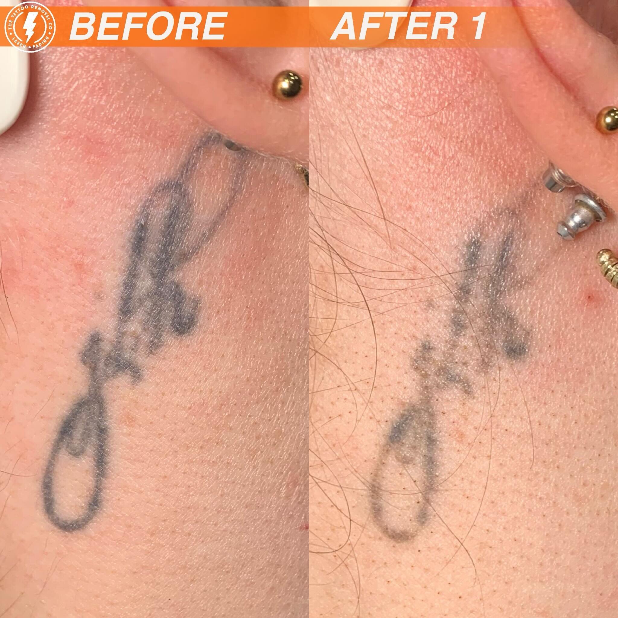BEFORE/AFTER 1 TREATMENT💥

Sorry to say mate but we are all watching you disappear.

⚡️Fabulous result so far. These are the results you get with our experienced and knowledgeable Laser Technician @philly_ttrc_pagdin ⚡️

Consultations are FREE pleas