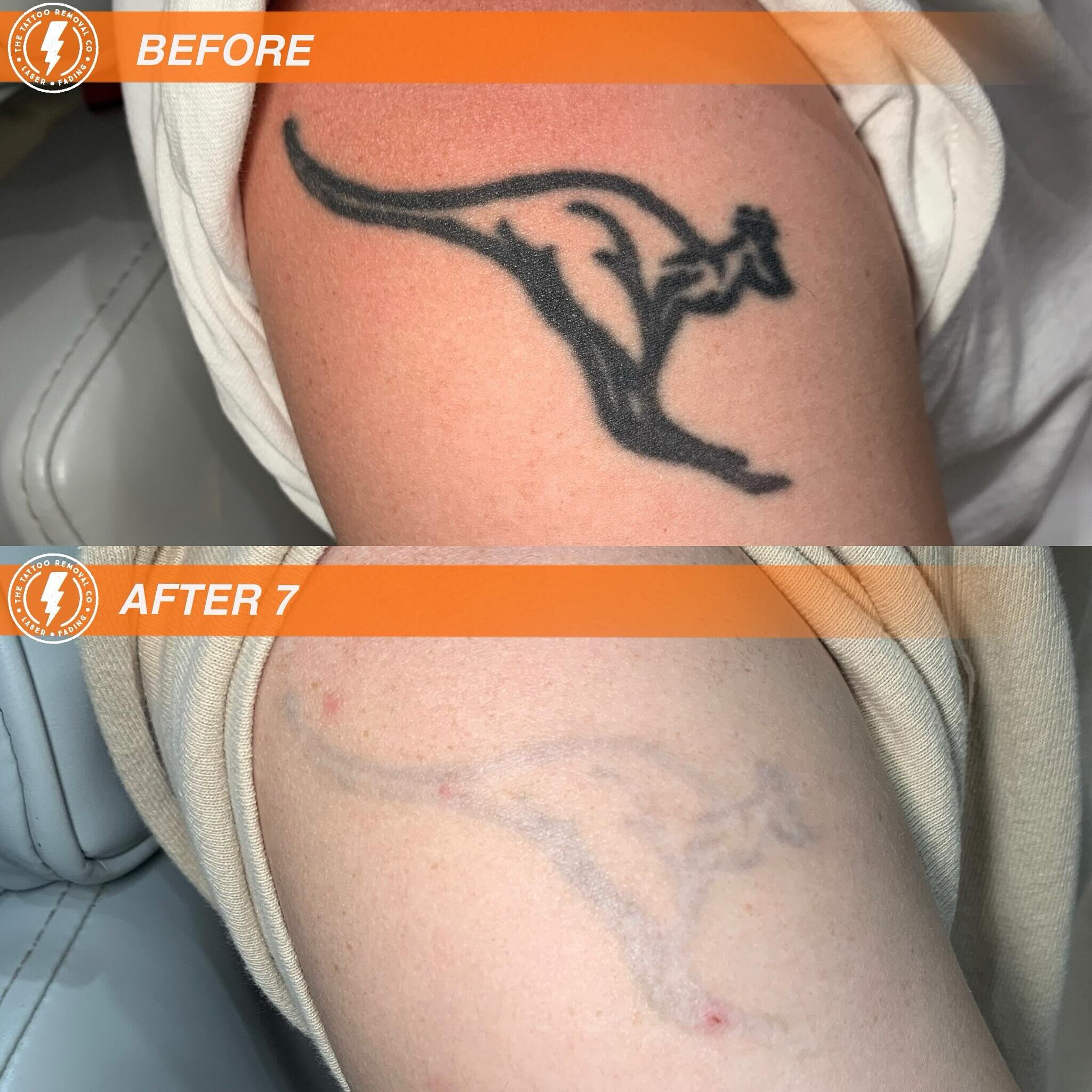 BEFORE/AFTER 7 TREATMENTS💥

Remember that time that Skippy bounced on past?

⚡️Fabulous result so far. These are the results you get with our experienced and knowledgeable Laser Technician @philly_ttrc_pagdin ⚡️

Consultations are FREE please don&rs