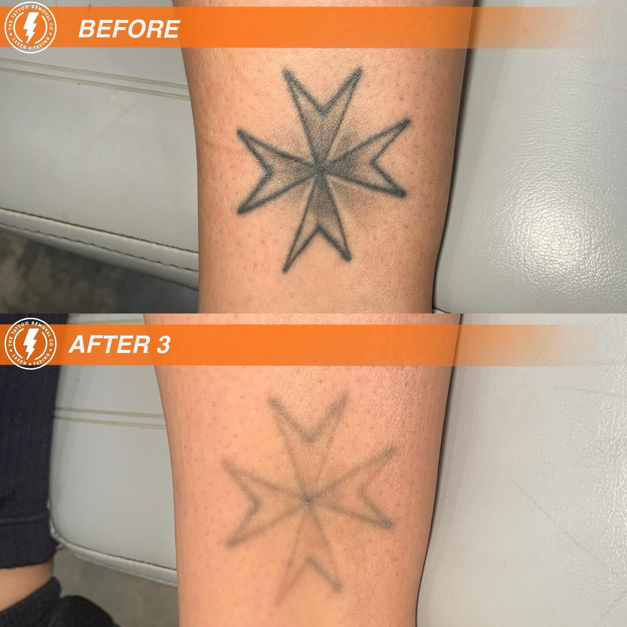 BEFORE/AFTER 3 TREATMENTS💥

Coming to the aid for this client. 

⚡️Fabulous result so far. These are the results you get with our experienced and knowledgeable Laser Technician @philly_ttrc_pagdin ⚡️

Consultations are FREE please don&rsquo;t hesita