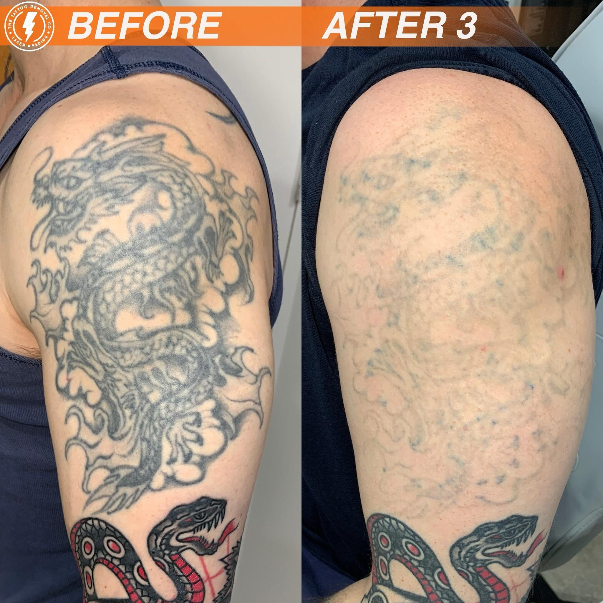 BEFORE/AFTER 3 TREATMENTS💥

The year of the Faded Dragon. 

⚡️Fabulous result so far. These are the results you get with our experienced and knowledgeable Laser Technician @philly_ttrc_pagdin ⚡️

Consultations are FREE please don&rsquo;t hesitate to