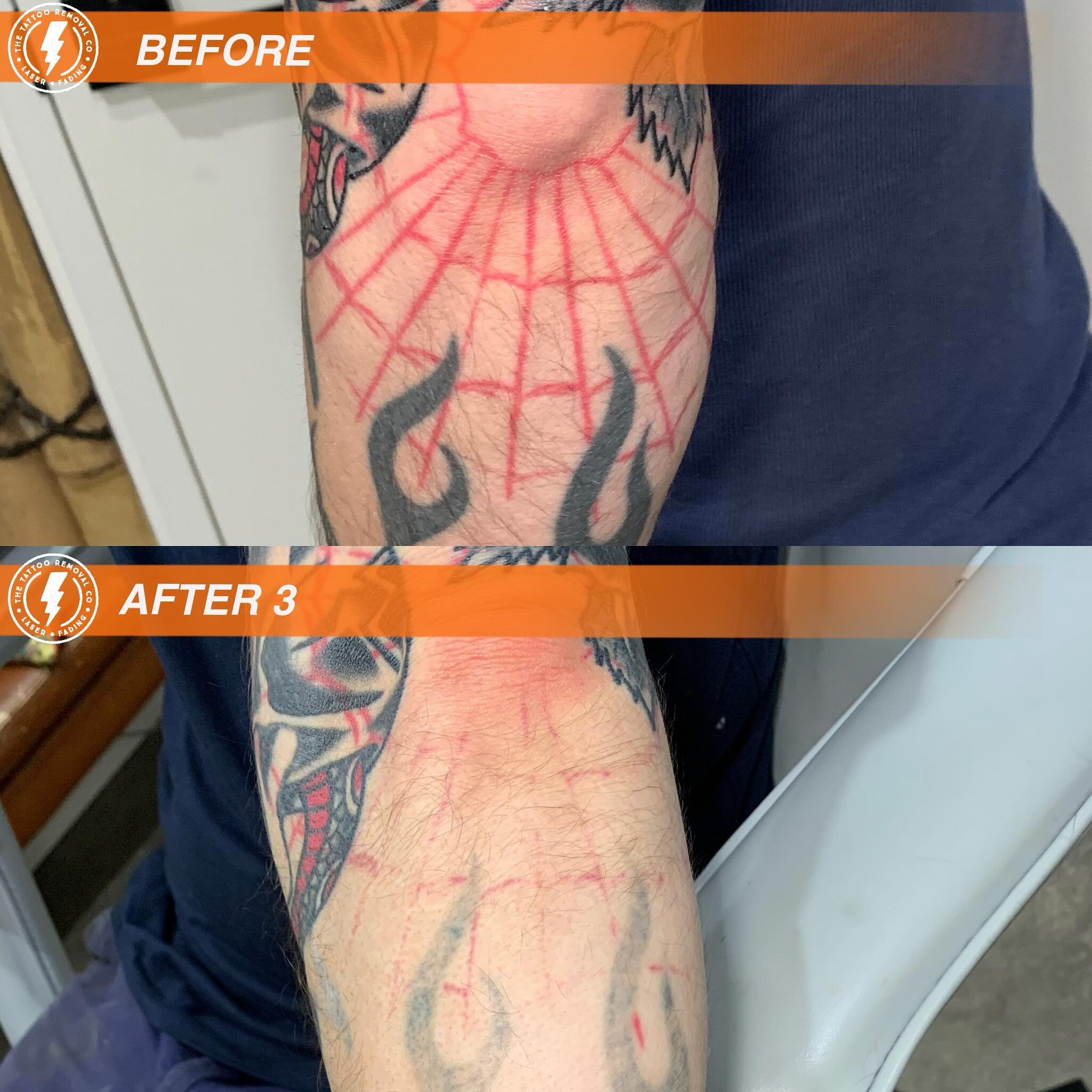 BEFORE/AFTER 3 TREATMENTS💥

We have been lucky enough to pull the red quicker then black. 

⚡️Fabulous result so far. These are the results you get with our experienced and knowledgeable Laser Technician @philly_ttrc_pagdin ⚡️

Consultations are FRE