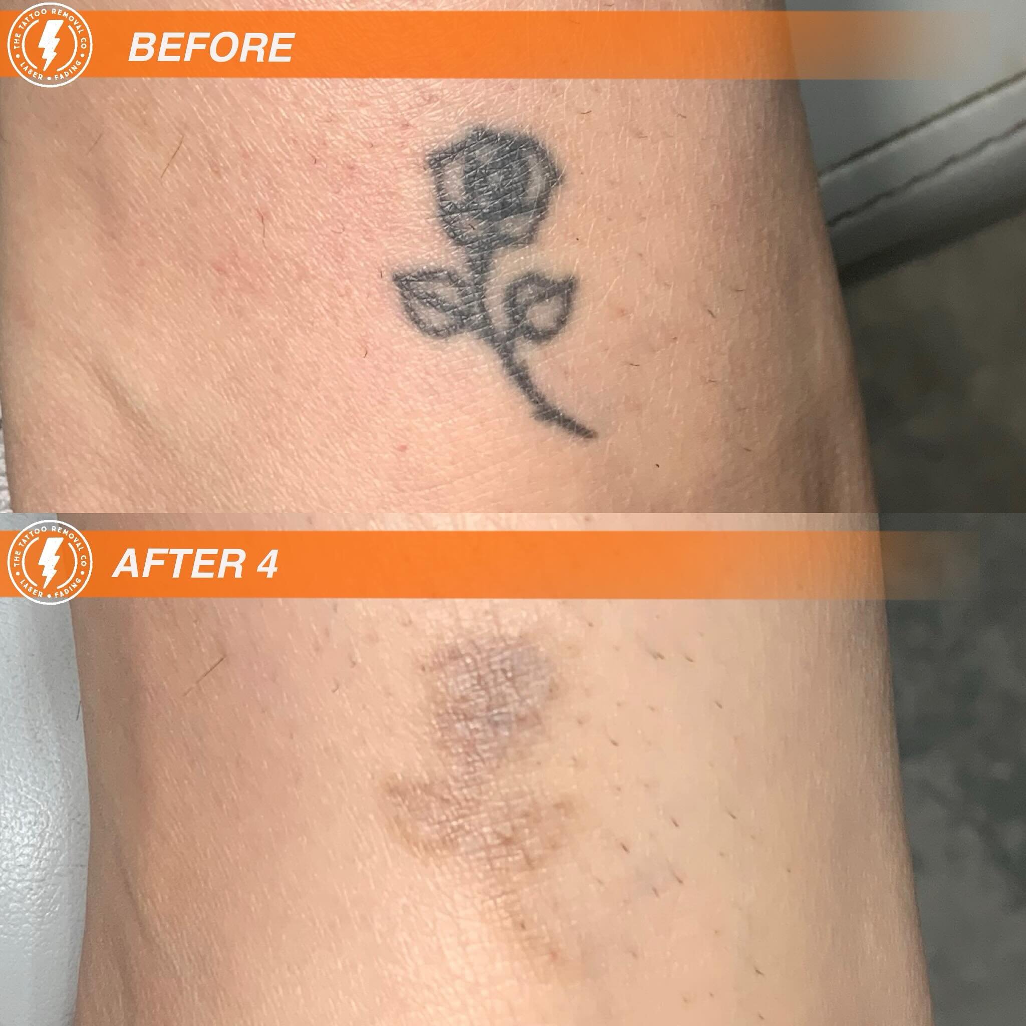 BEFORE/AFTER 4 TREATMENTS💥

Every rose has its thorns until it fades away 🌹

⚡️Fabulous result so far. These are the results you get with our experienced and knowledgeable Laser Technician @philly_ttrc_pagdin ⚡️

Consultations are FREE please don&r